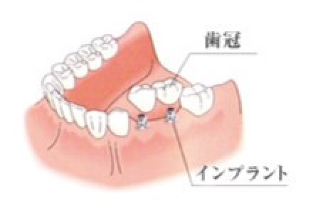 インプラント治療例