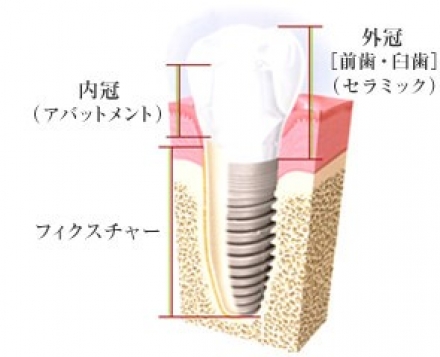 インプラント費用